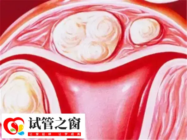 子宫内膜薄能不能做试管婴儿(图1) 子宫内膜薄做试管婴儿能实现生育