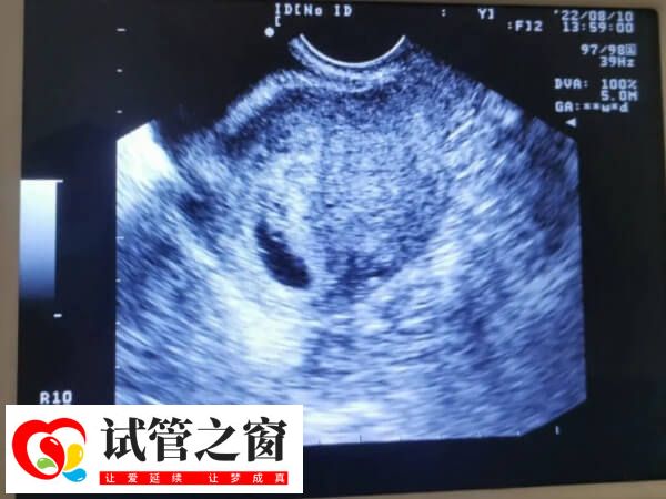 试管二超胎芽长度是否正常要看患者情况