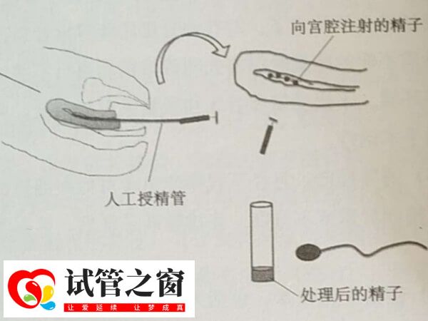 人工授精的成功率有多高?能达到20%吗?(图1) 人工授精成功率不高