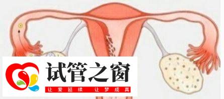 多囊卵巢综合症对日常生活的六大影响?(图1) 多囊卵巢综合症对日常生活的六大影响?(图1)