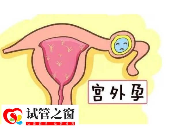 宫外孕早期的征兆有哪些(图2) 导致宫外孕的原因